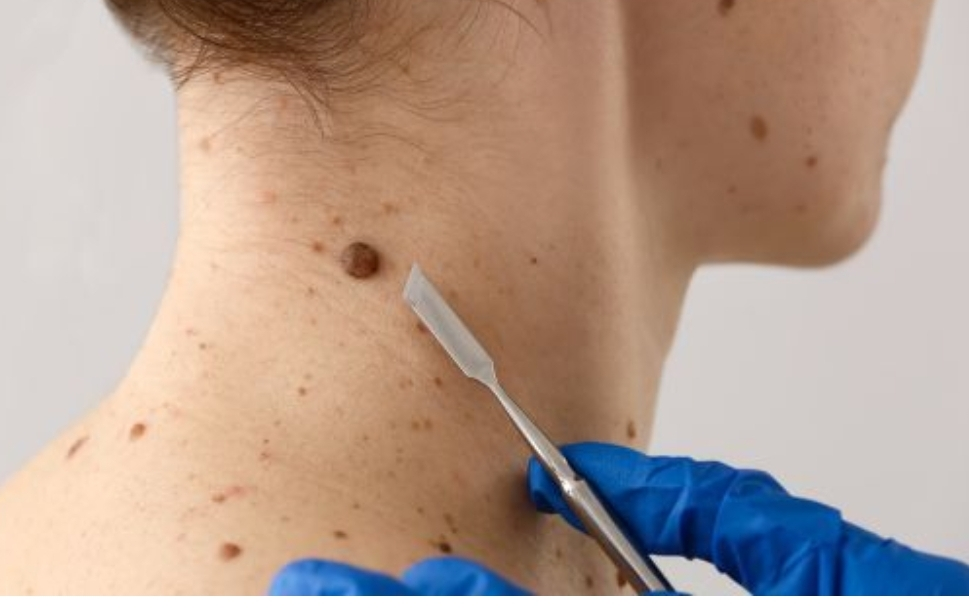 Prefeitura de Cáceres amplia atendimento dermatológico e reforça cuidado com a saúde da pele